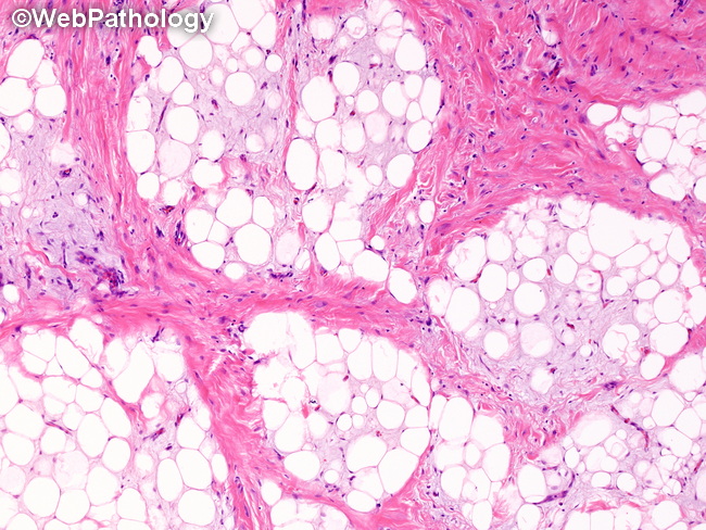 Soft Tissue_Lipomatous_Lipoblastoma10.jpg
